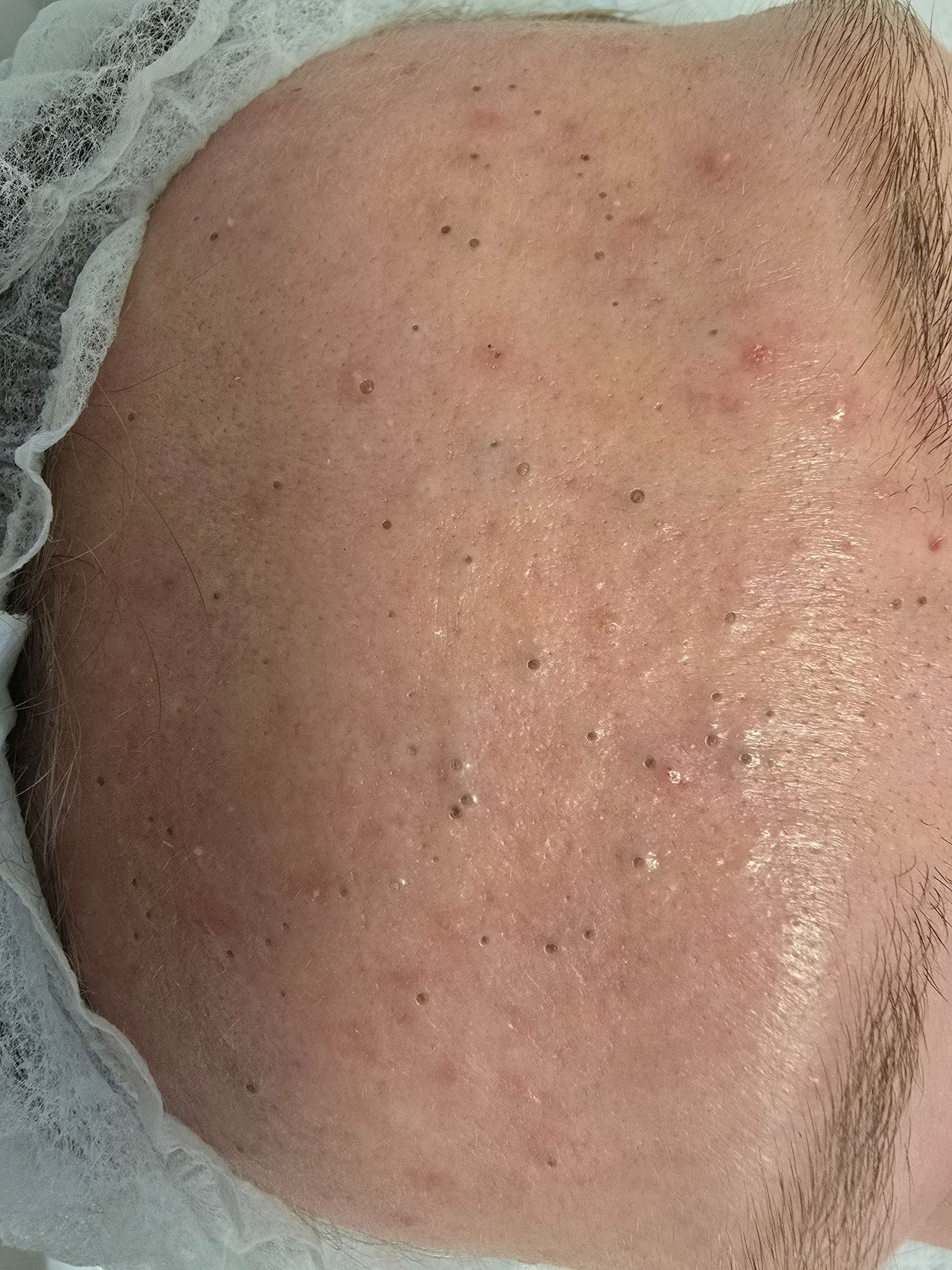 Close-up of a person's face with oily skin, small blackheads, and some redness.