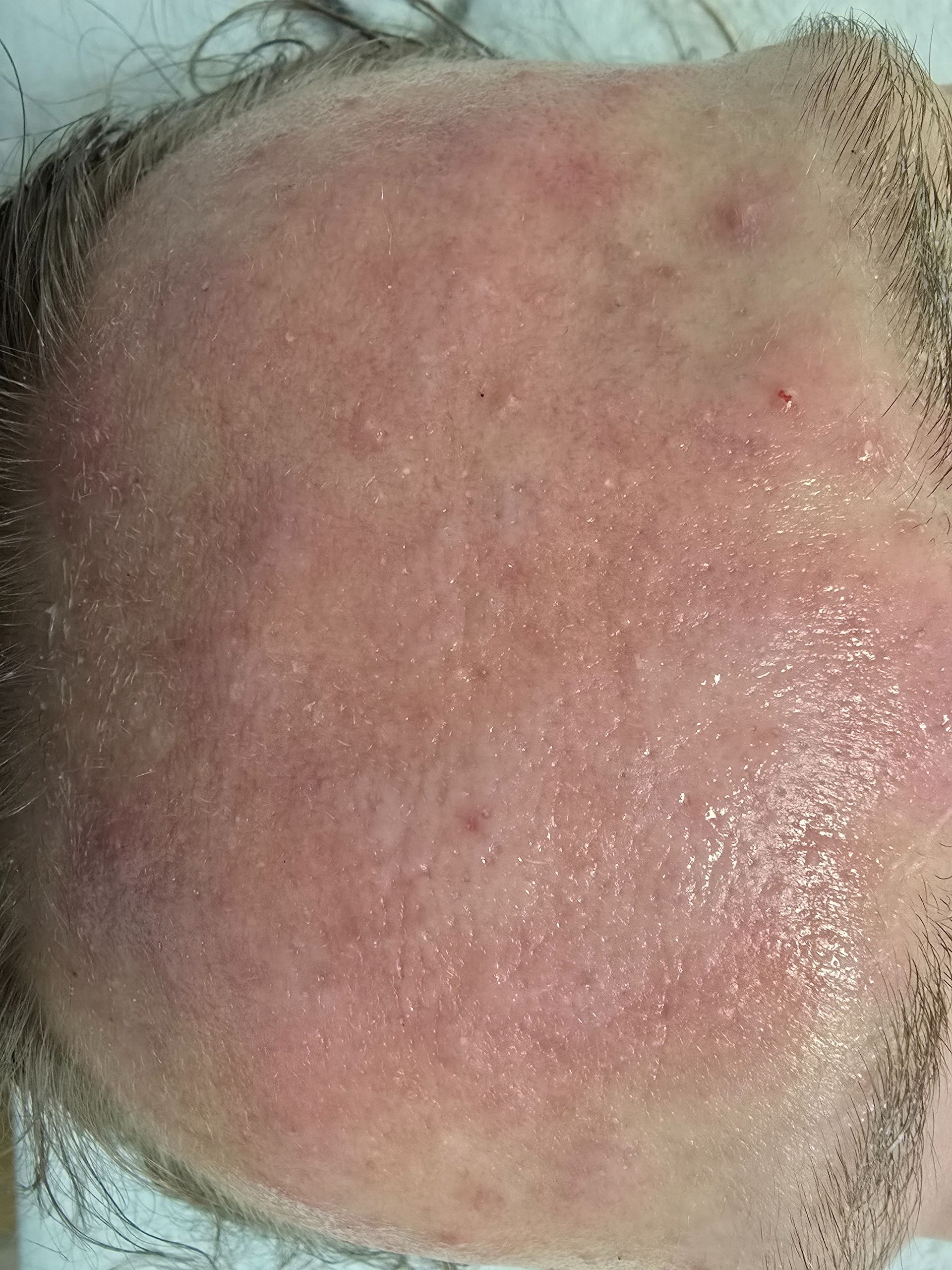 Close-up of a person's forehead with a red, irritated skin condition, some small pimples and sweat present.