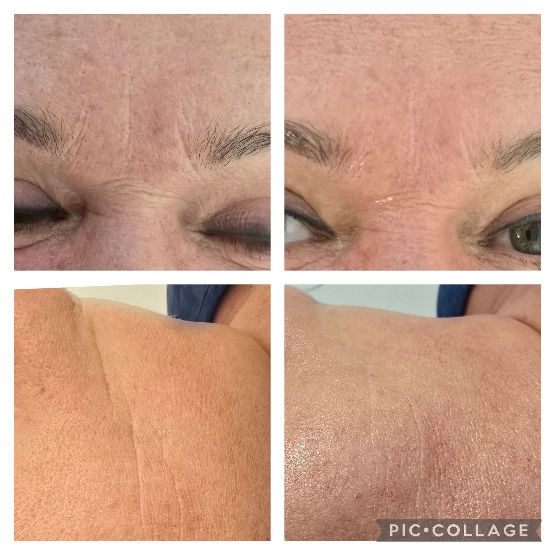 Collage showing wrinkled skin before and after a procedure, around eyes and on shoulder.