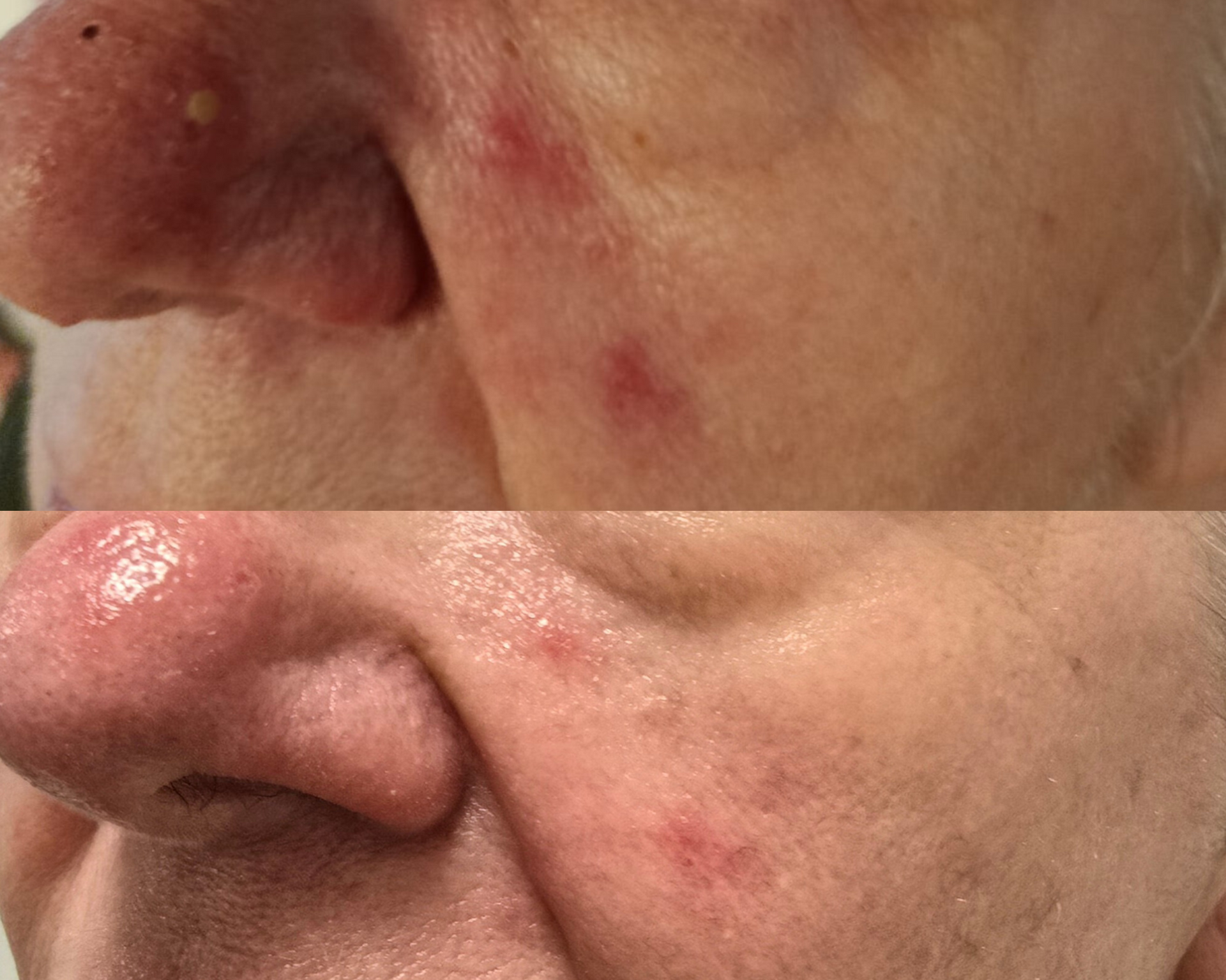 Top: Close-up of a face with inflamed red spots on the cheek and nose. Bottom: The same face with less redness.
