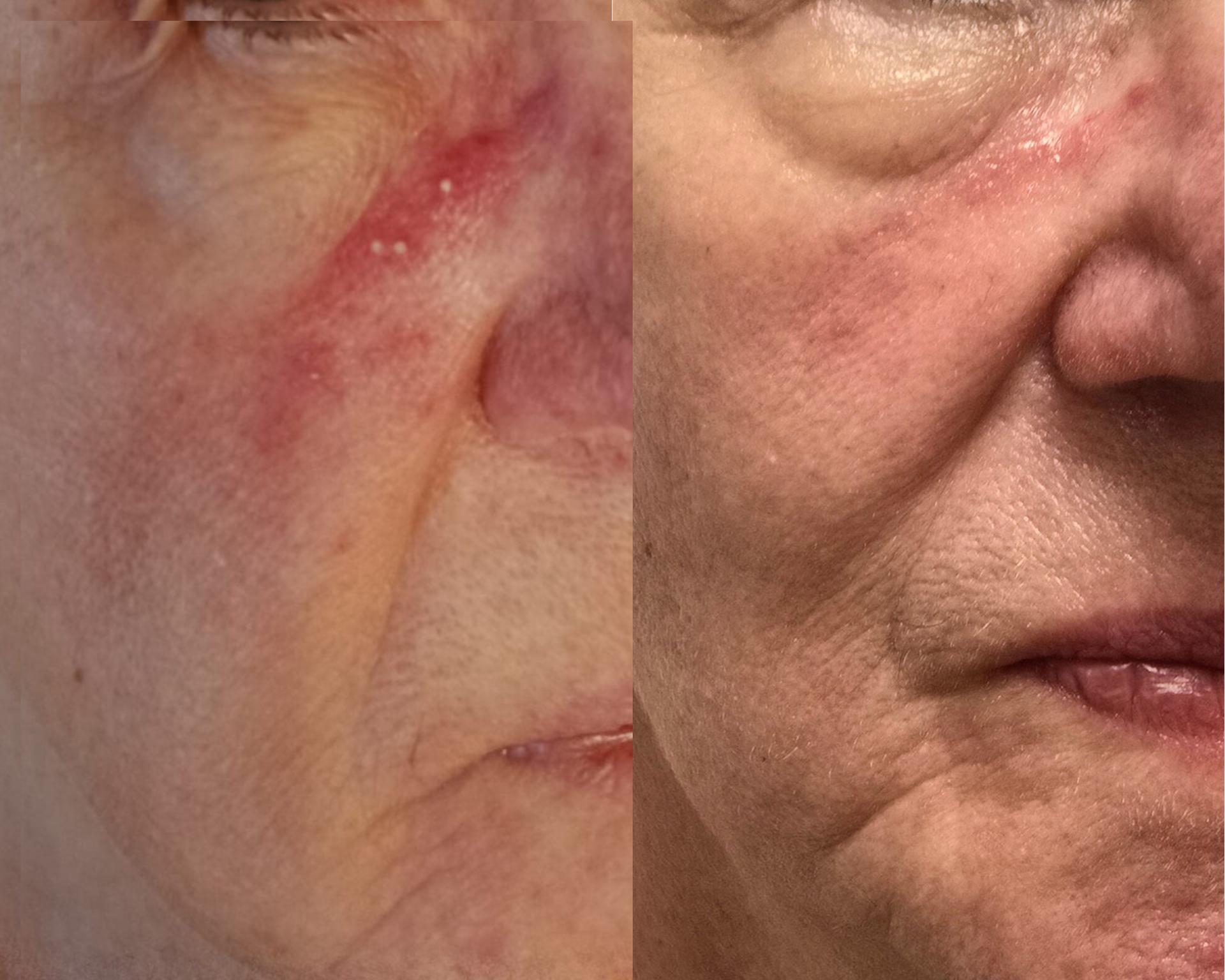 Comparison of a person's face with a red, irritated rash around the eye and nose, before and after treatment.