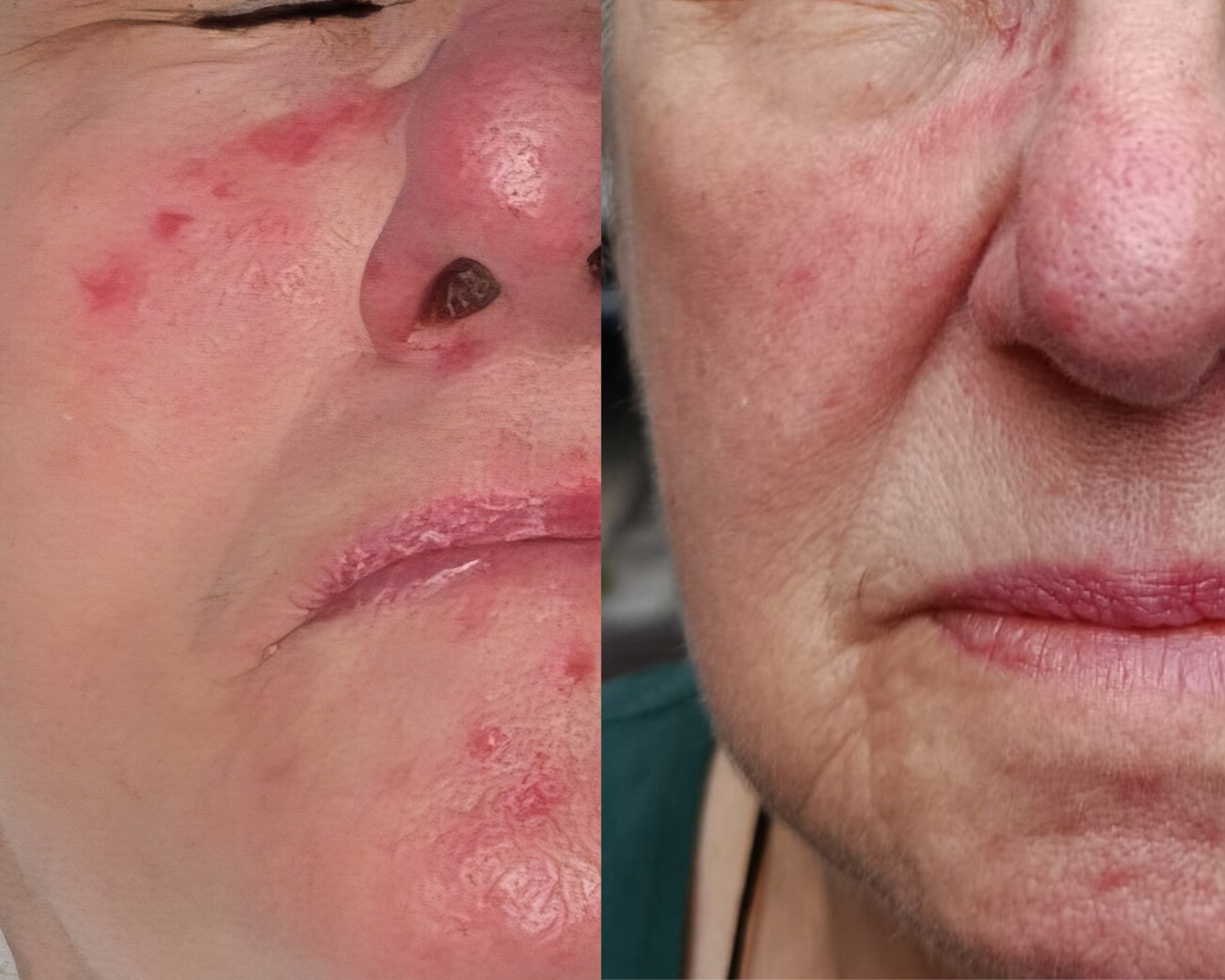 Before and after photos of a woman's face with facial redness and skin lesions.