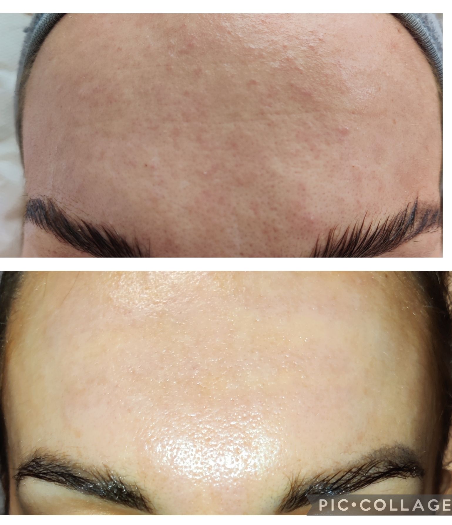 Before and after comparison of a person's forehead, showing skin texture improvement.