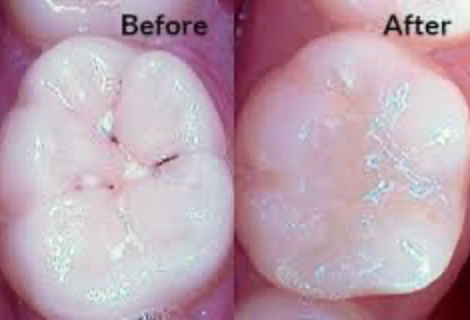 Tooth-Colored Fillings
