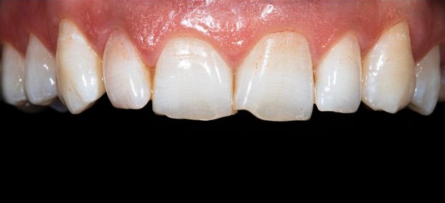 Close-up of upper front teeth with a noticeable gap between the two center incisors