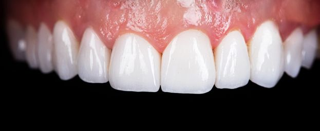 Close-up of white upper teeth and pink gums smiling against a black background