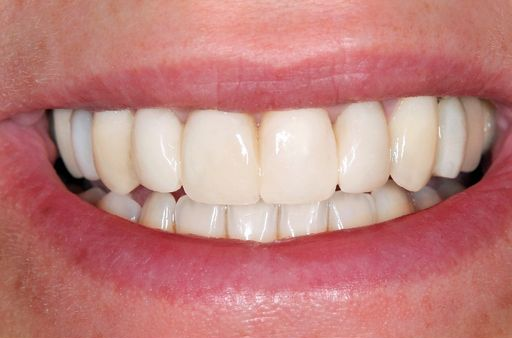 Close-up of a smiling mouth showing straight white teeth