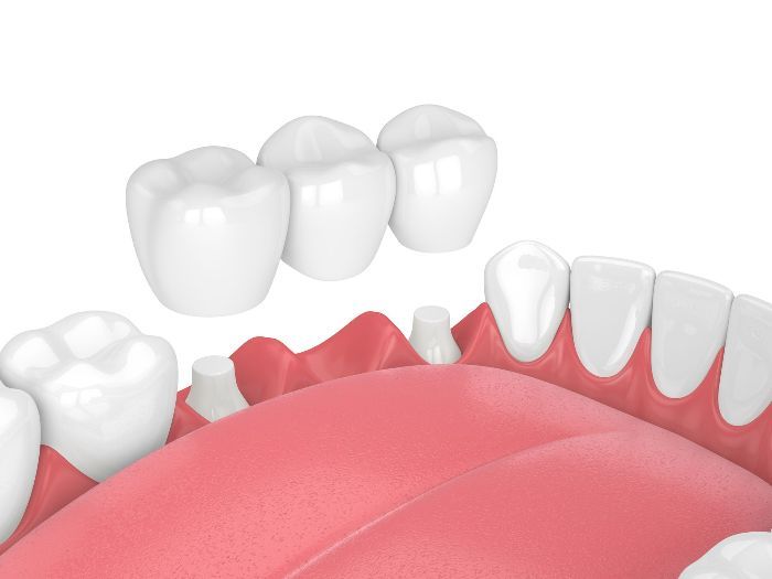 Tooth and gum illustration showing several white teeth above red gums