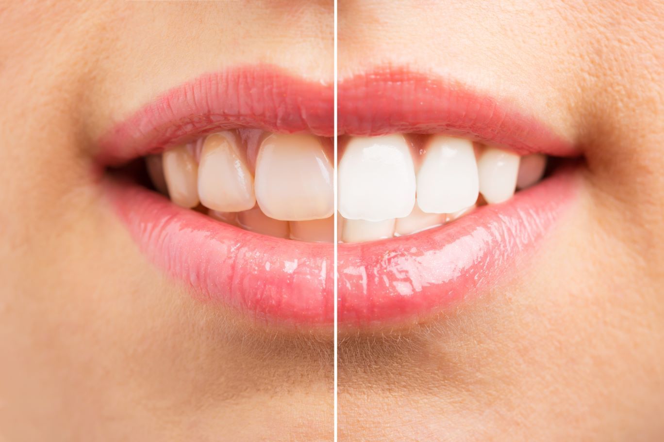 A before and after picture of a woman 's teeth near Wake Forest, NC.