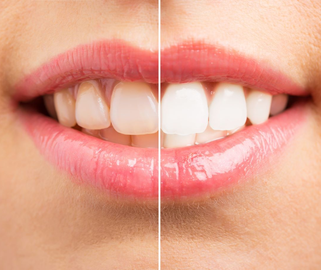 A before and after picture of a woman 's teeth near Garner, NC.