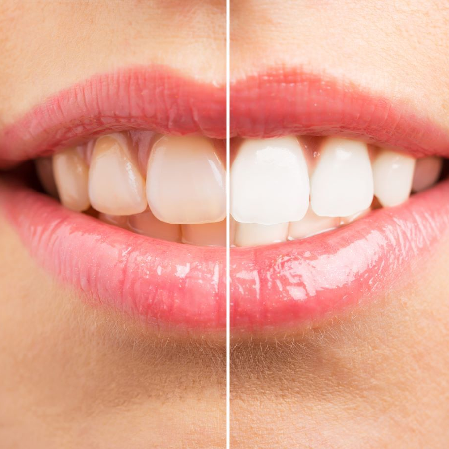 A before and after picture of a woman 's teeth in Knightdale, NC.