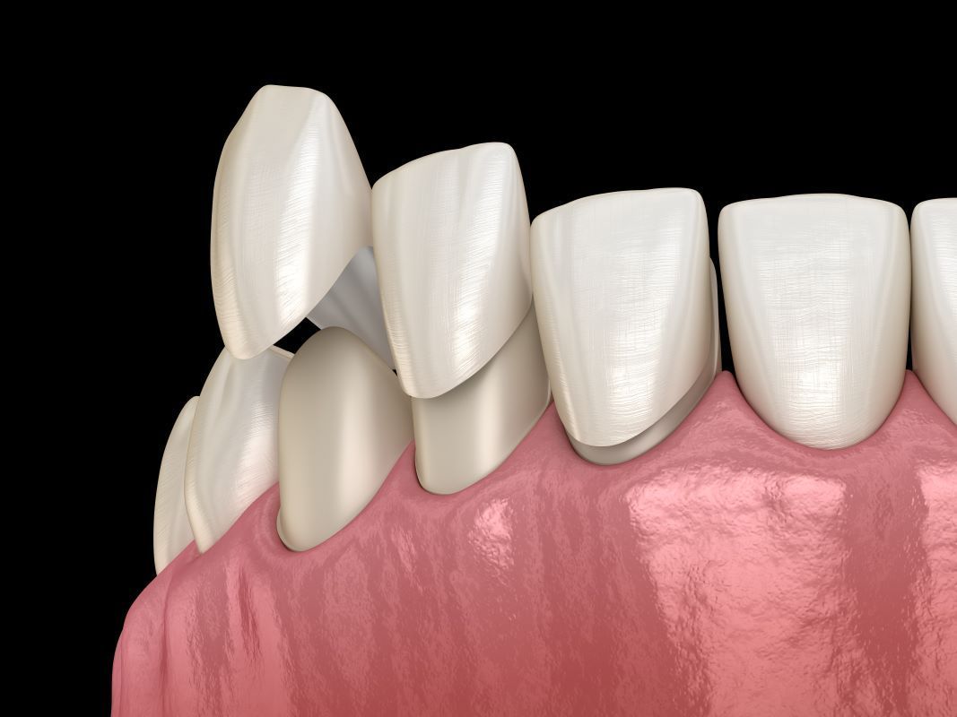 A close up of a person 's teeth with a tooth missing