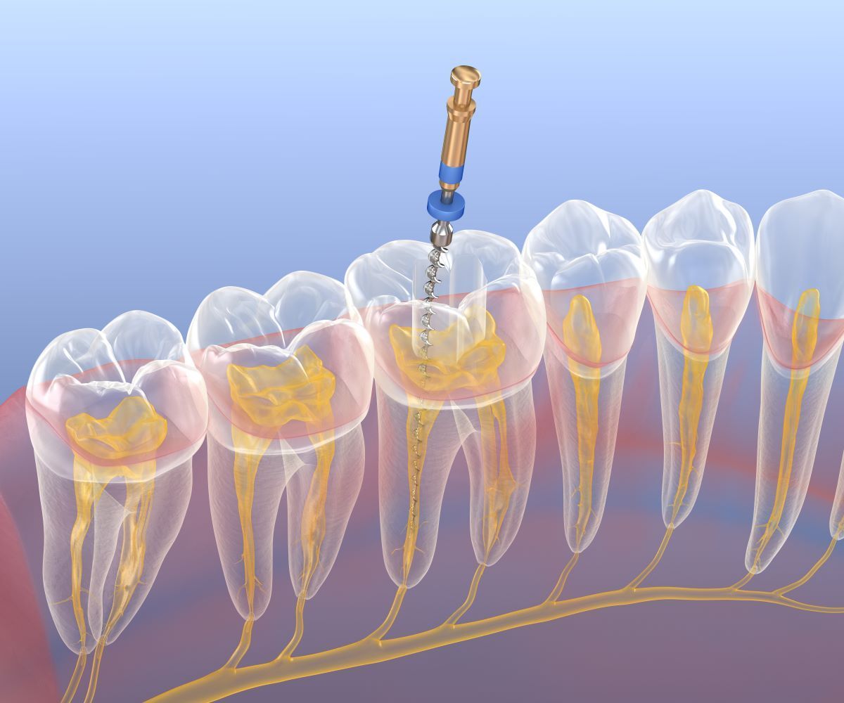 A computer generated image of a dental procedure being performed on a row of teeth.