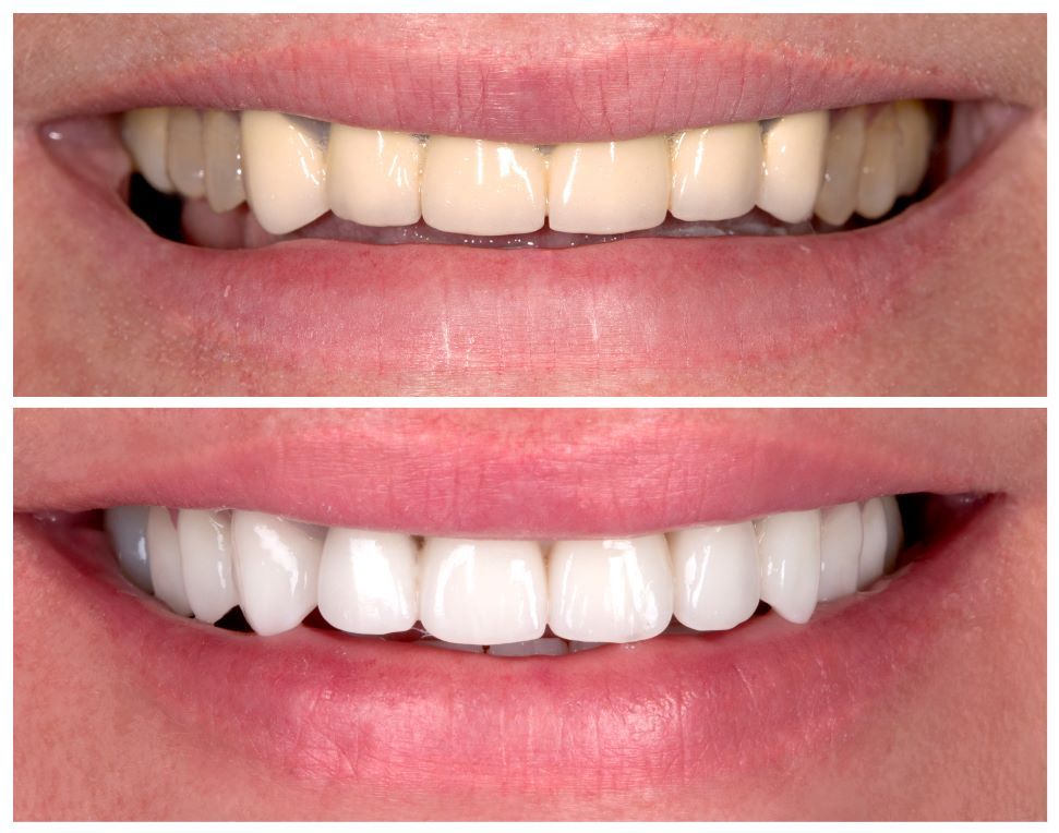 A before and after picture of a person 's teeth.