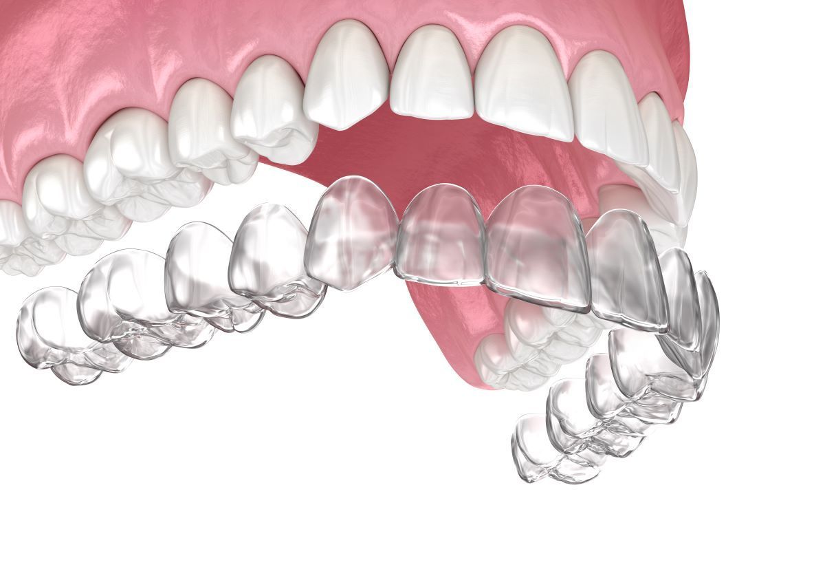 A close up of a person 's teeth with clear braces.