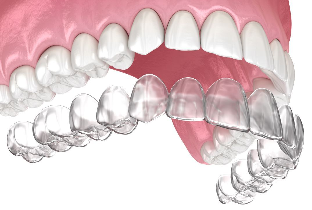 Transparent aligners on upper and lower teeth in a mouth model for Wake Forest NC residents