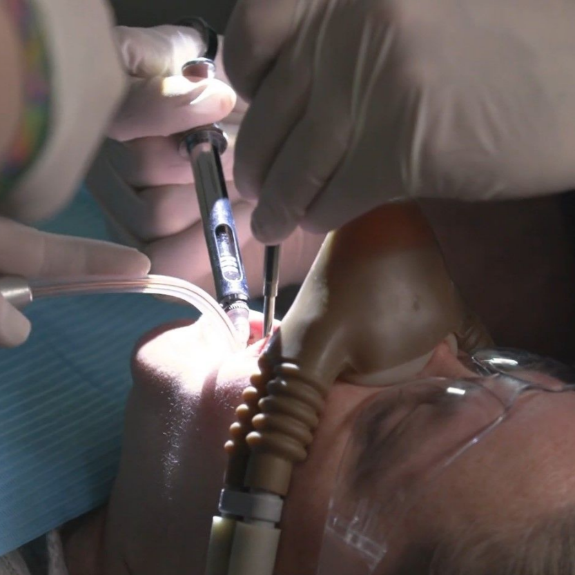 A patient is wearing a sedation mask and getting dental work done in Knightdale, NC