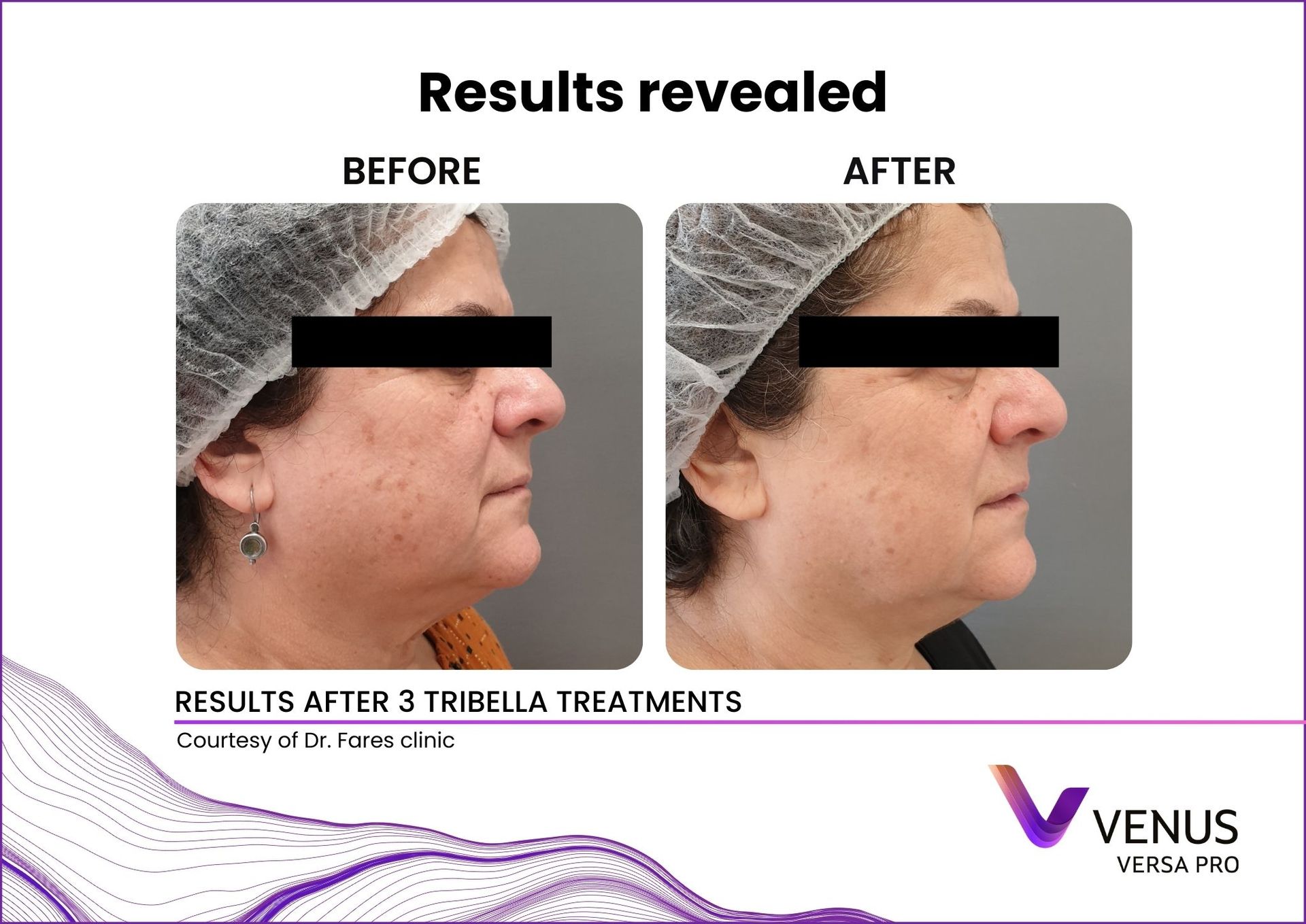Venus Versa™ Pro Treatments | Prana Relax Spa