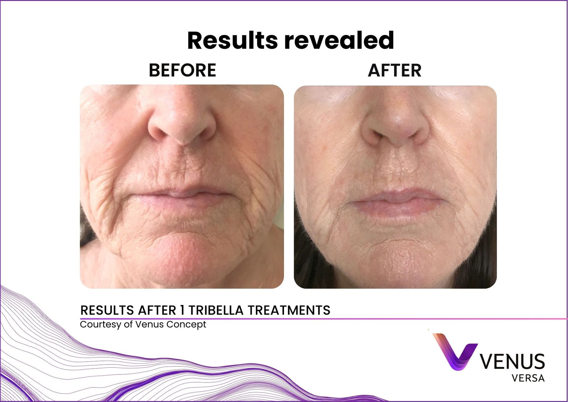 Venus Versa™ Pro Treatments | Prana Relax Spa