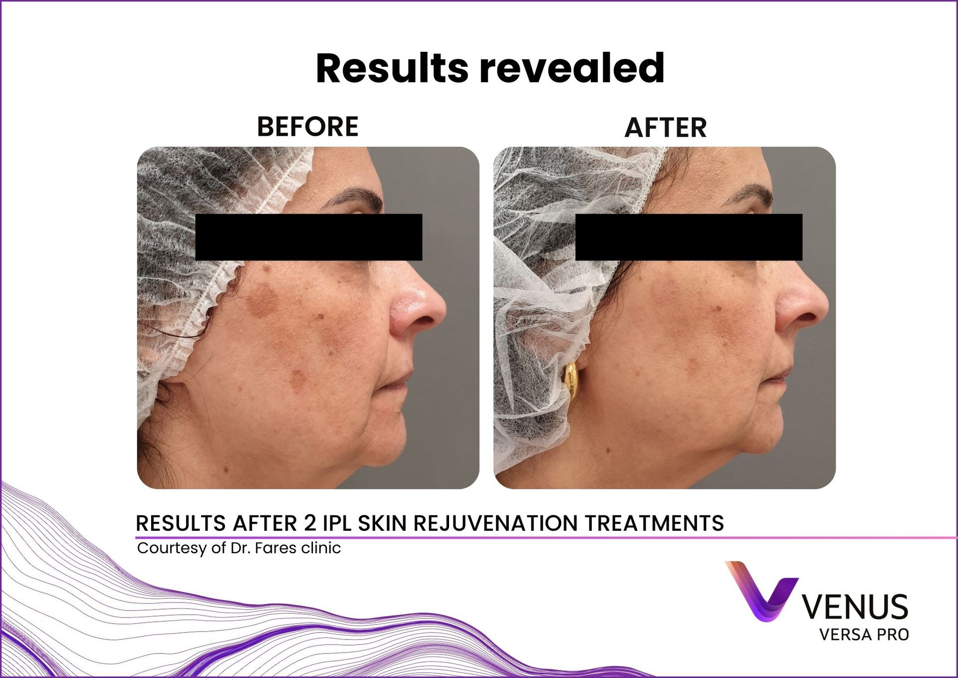 Venus Versa™ Pro Treatments | Prana Relax Spa