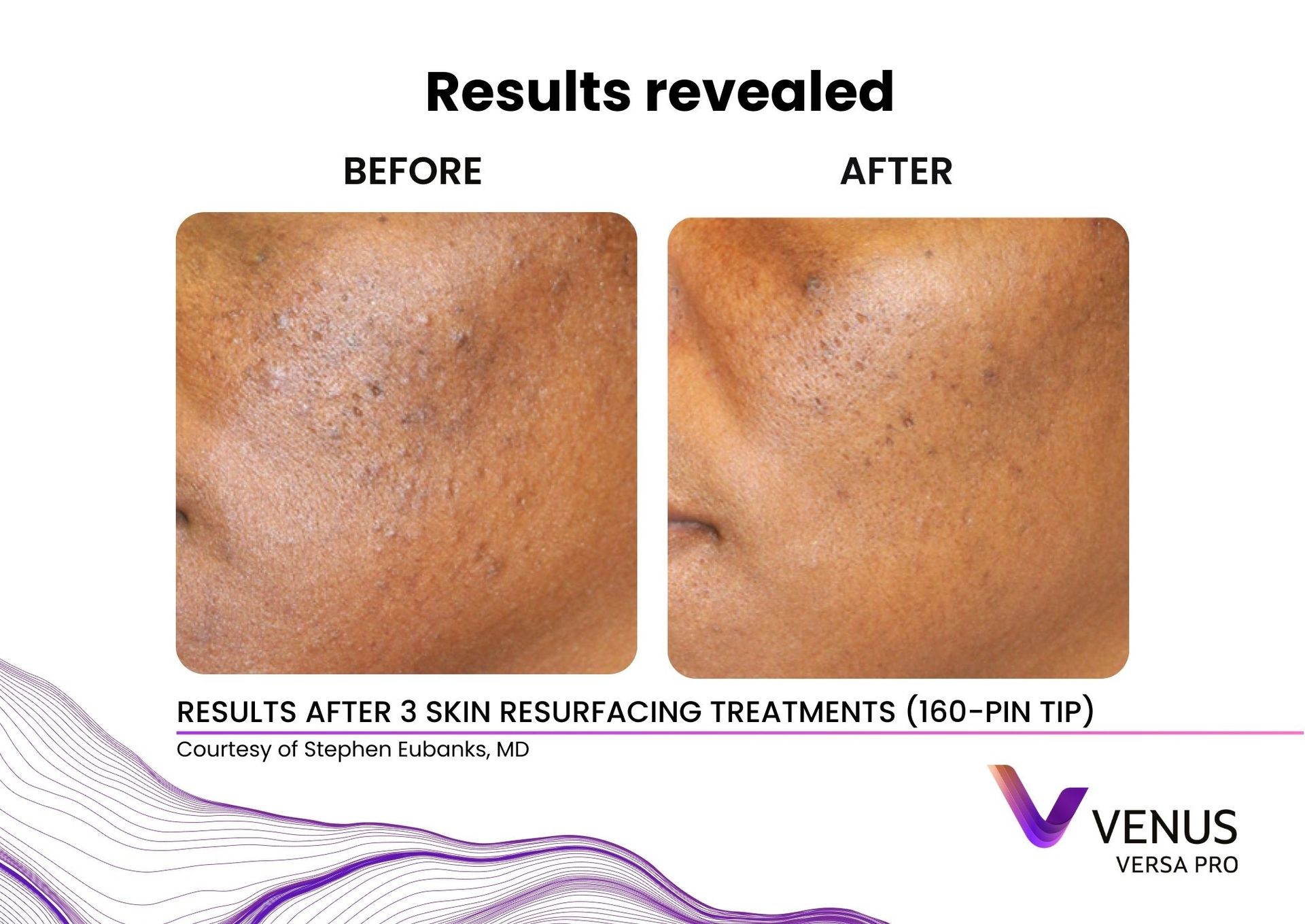Venus Versa™ Pro Treatments | Prana Relax Spa
