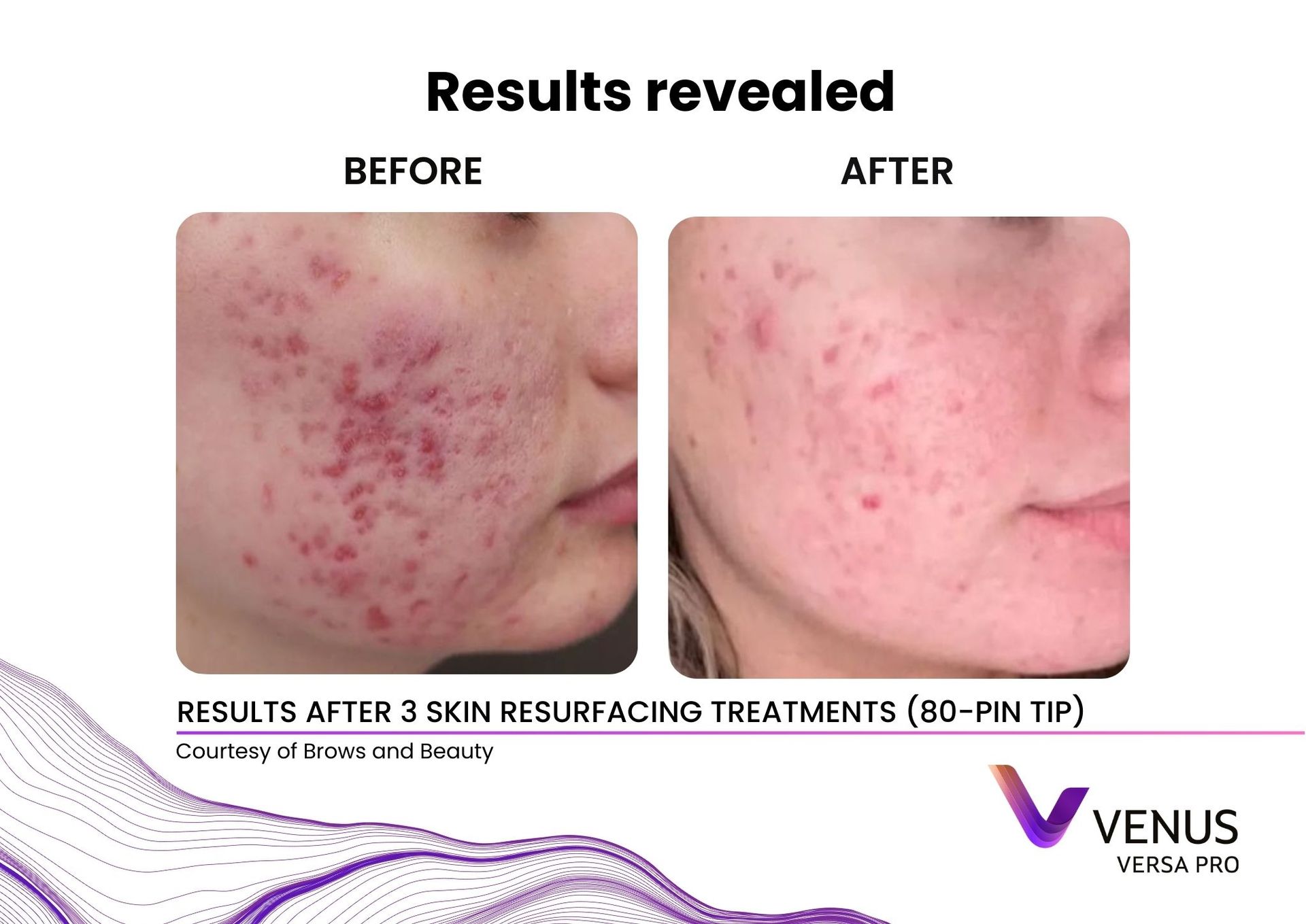 Venus Versa™ Pro Treatments | Prana Relax Spa