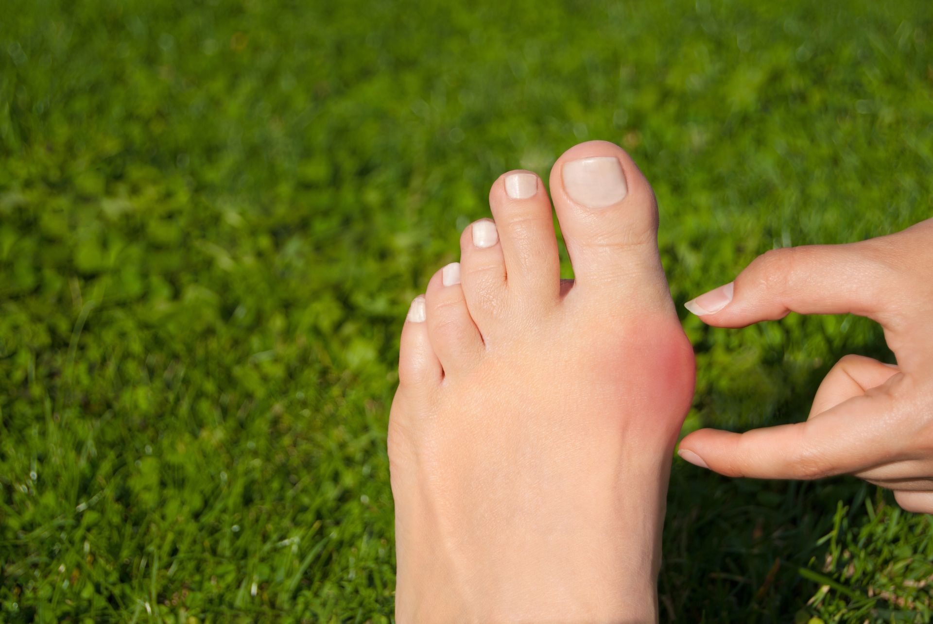 Foot with a red, swollen bunion being touched by a finger against green grass.