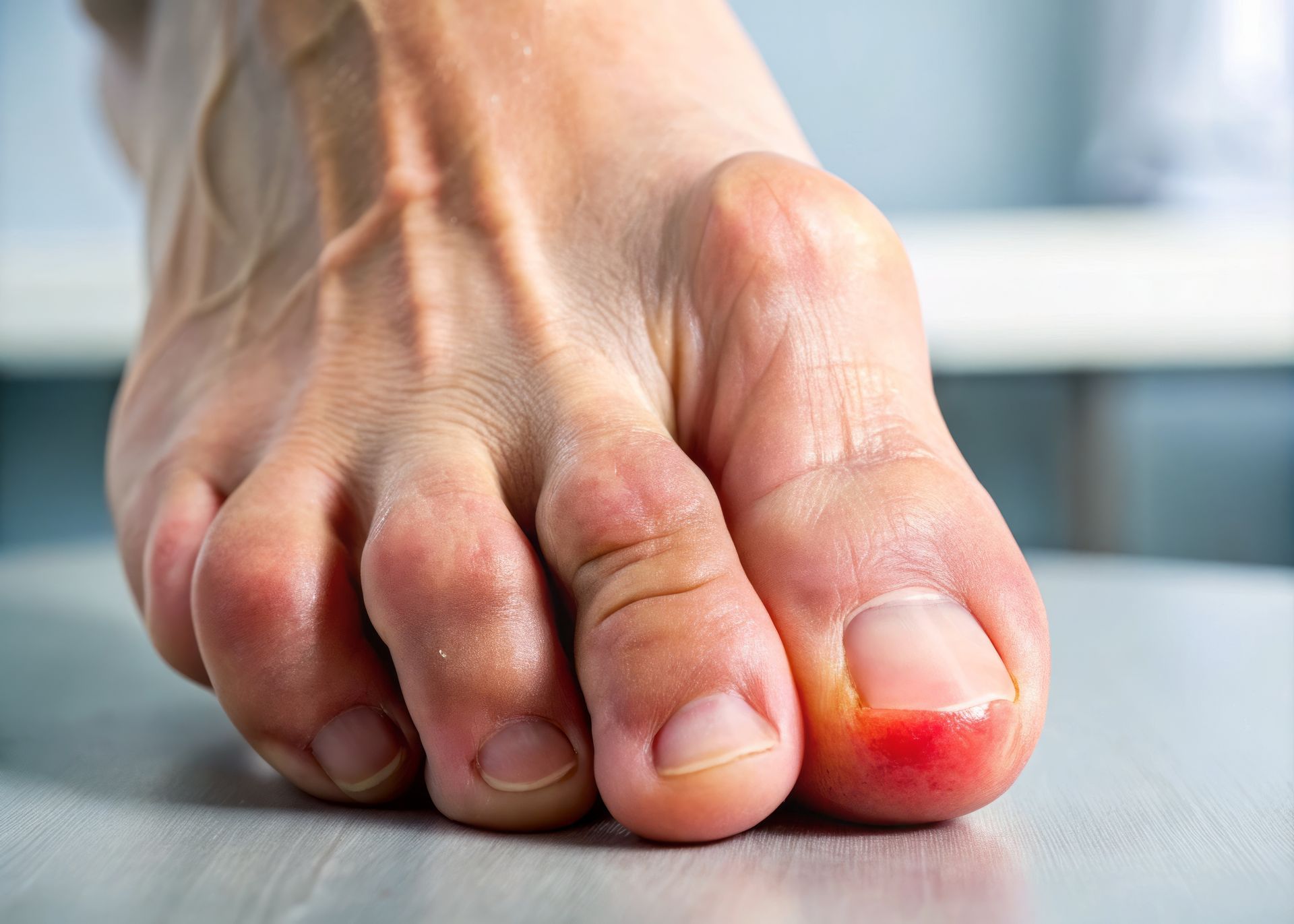 Close-up of a foot, focus on the big toe, which is red and inflamed, possibly infected.