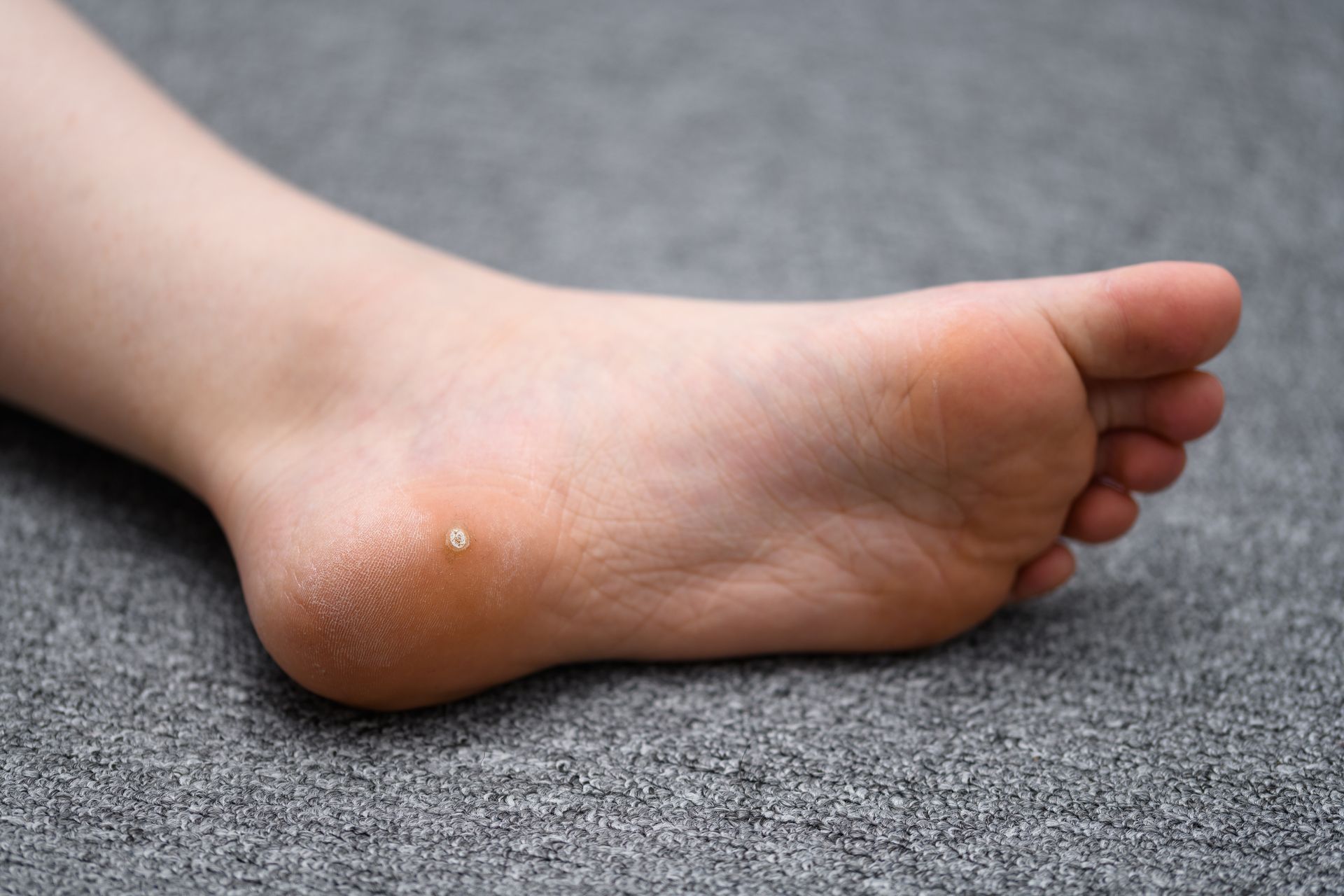 Sole of foot with a small, raised wart on the heel, on a gray carpet.
