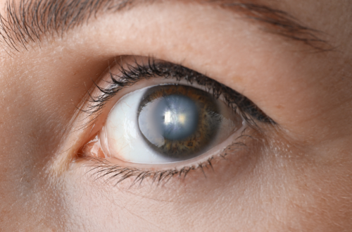 Cataract Awareness Month