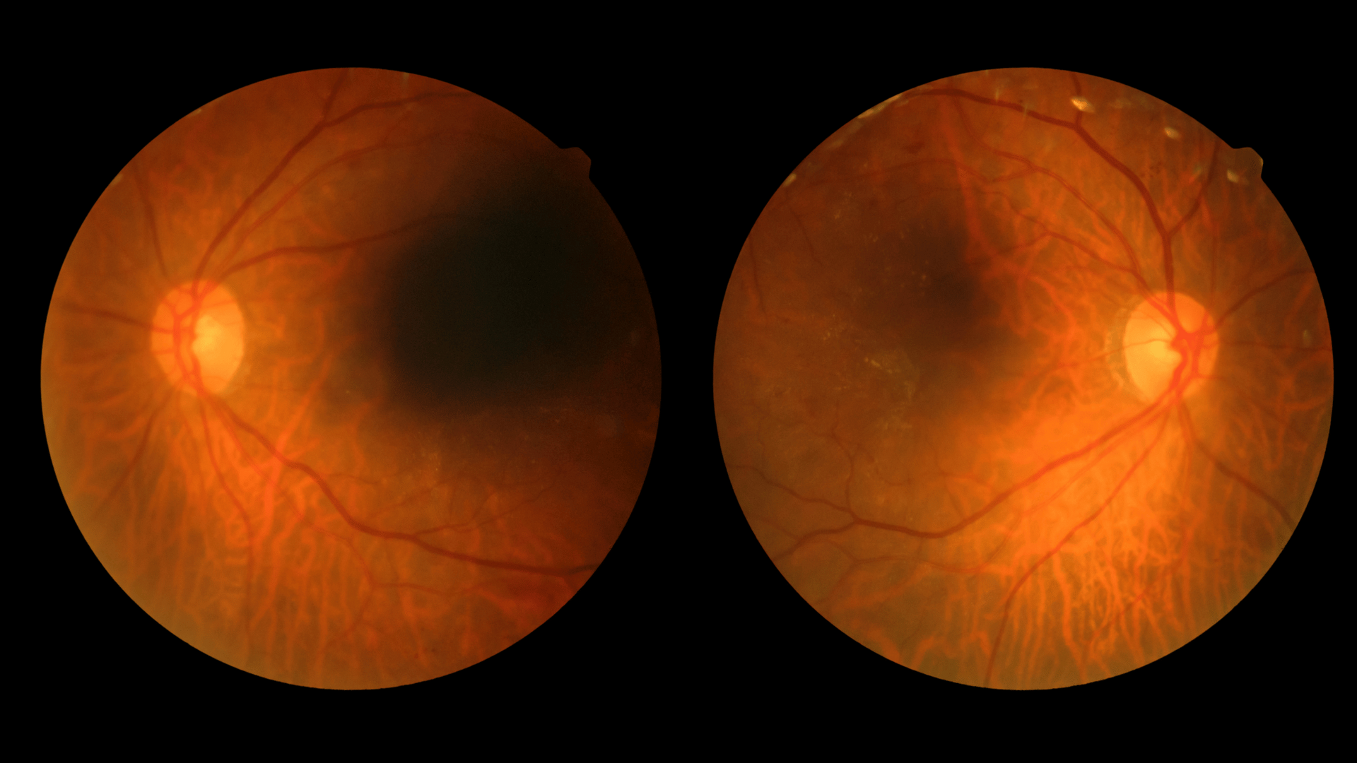 Diabetic Retinopathy and Diabetic Eye Disease Awareness