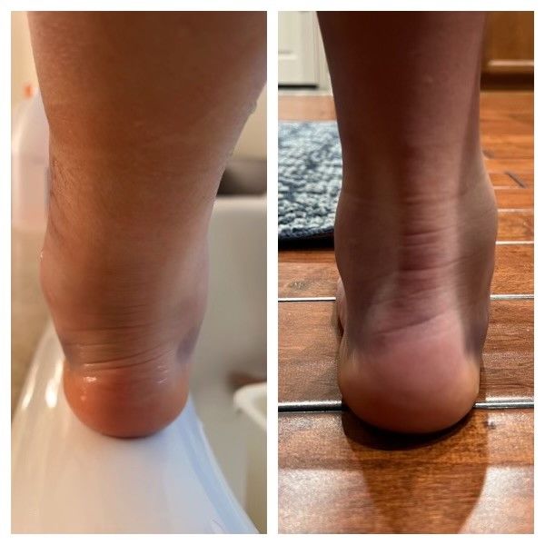 A side-by-side comparison of a human ankle showing swelling and bruising on the outer side.