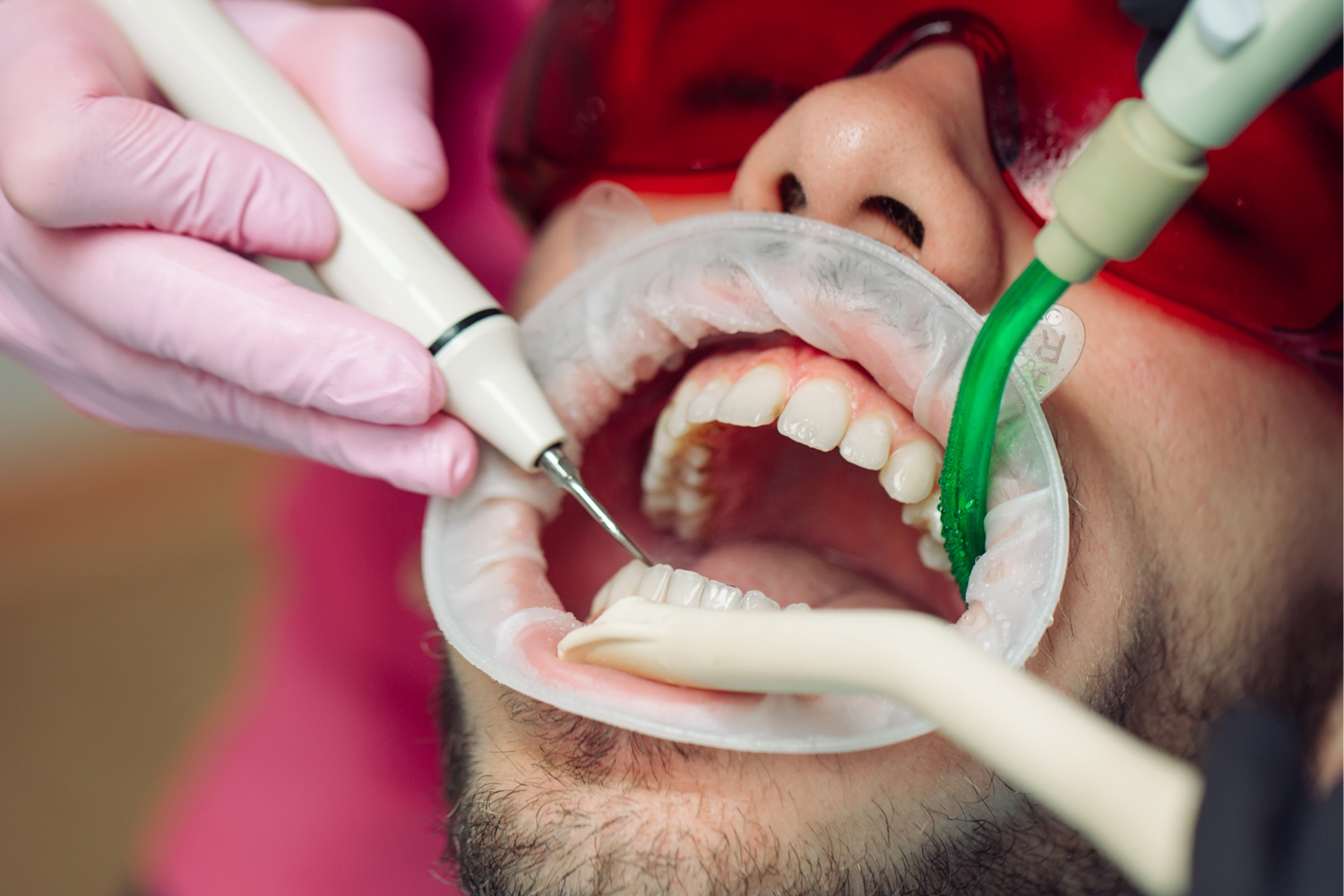 Dental tools working inside a patient’s open mouth during a procedure