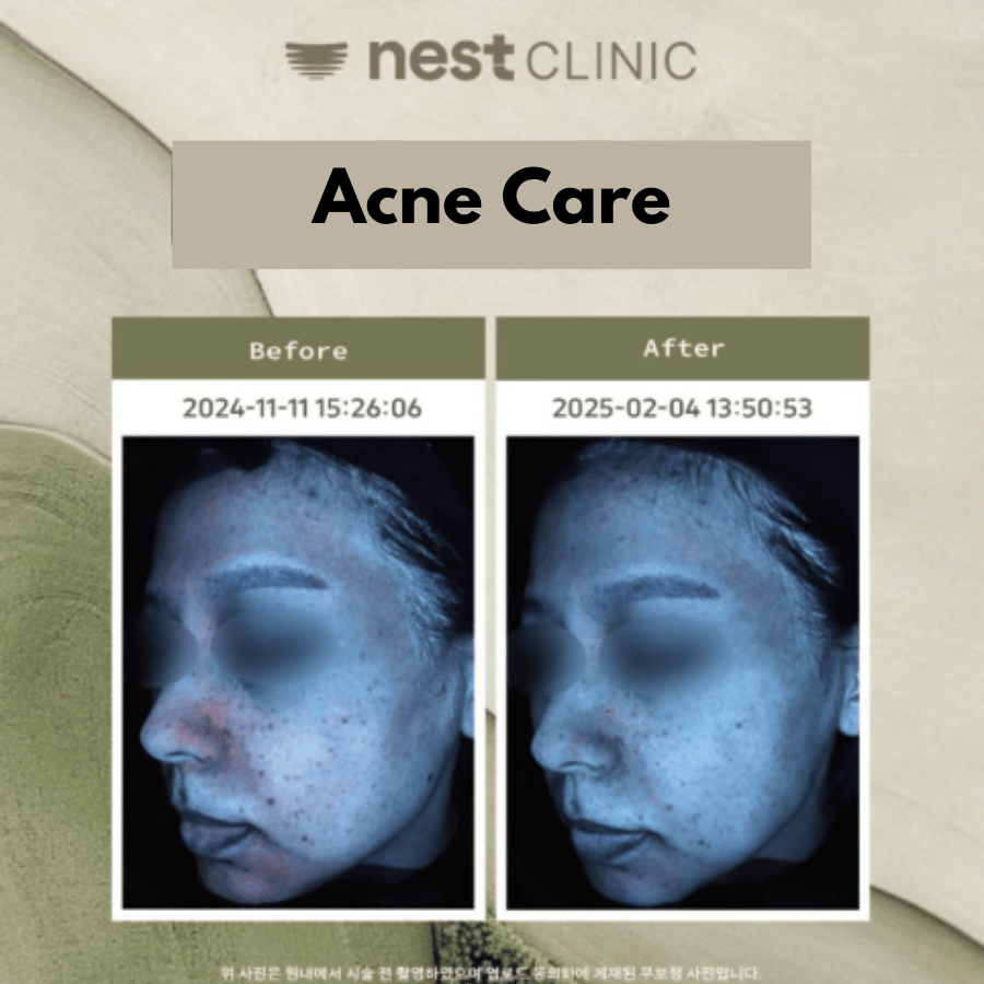 Acne care before and after at Nest Clinic Gangnam