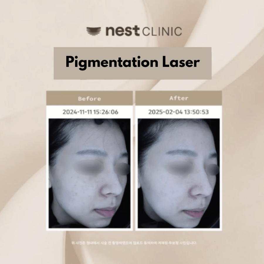 Pigmentation laser before and after at Nest Clinic Gangnam