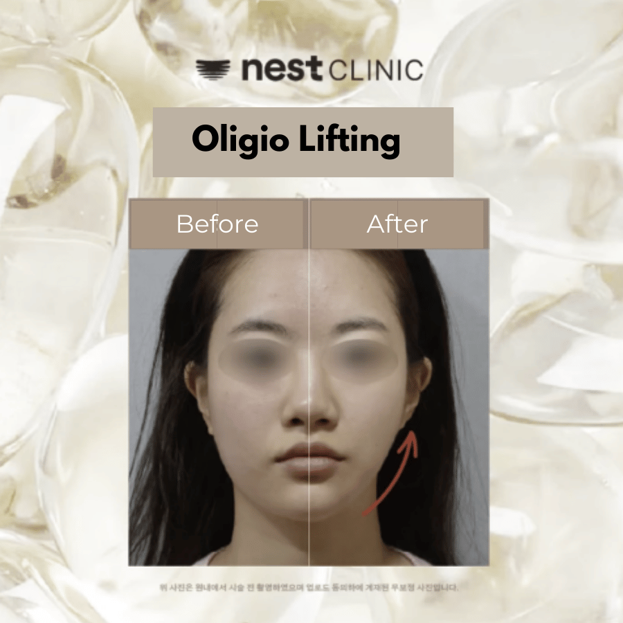 Oligio RF lifting before and after at Nest Clinic Gangnam
