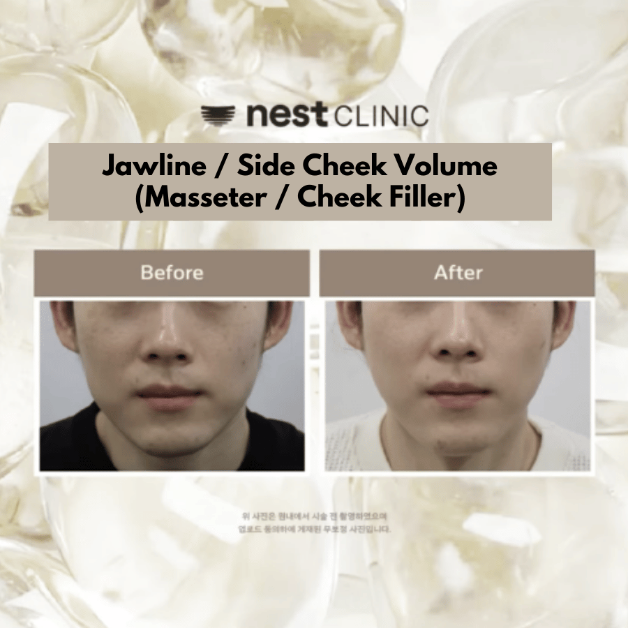 Jawline / side-cheek volume (masseter & cheek filler) before and after at Nest Clinic Gangnam