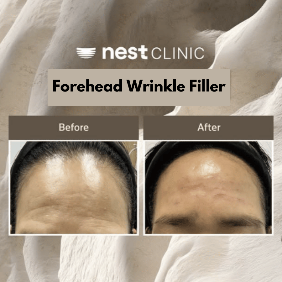 Forehead wrinkle filler before and after at Nest Clinic Gangnam