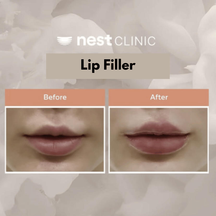 Lip filler before and after at Nest Clinic Gangnam