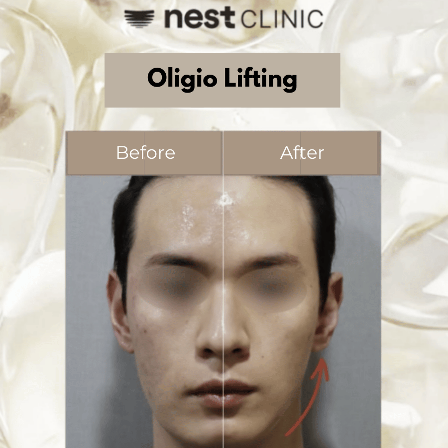 Oligio RF lifting before and after at Nest Clinic Gangnam