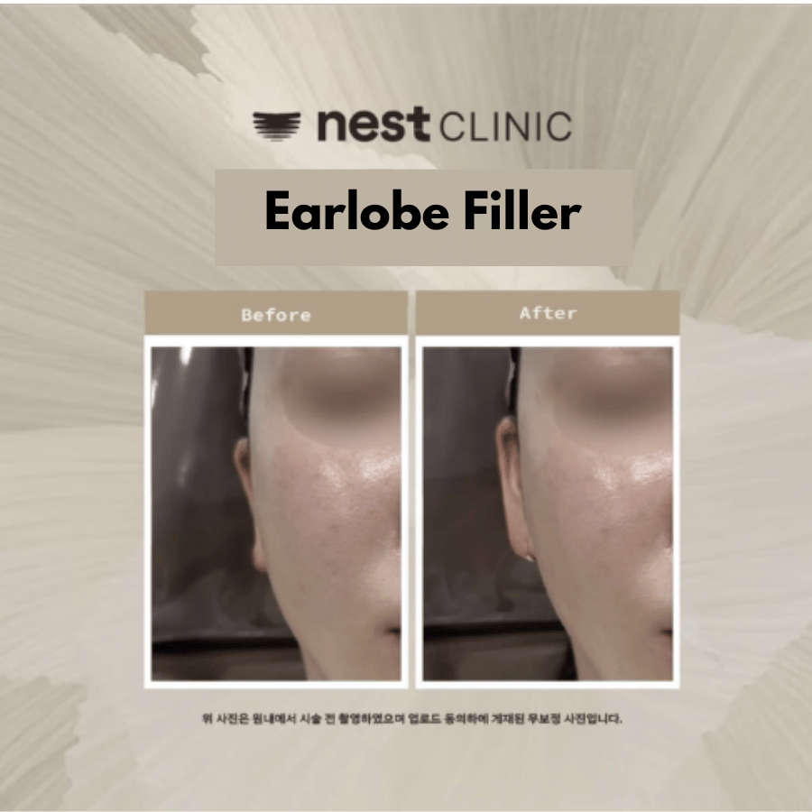 Earlobe filler before and after at Nest Clinic Gangnam