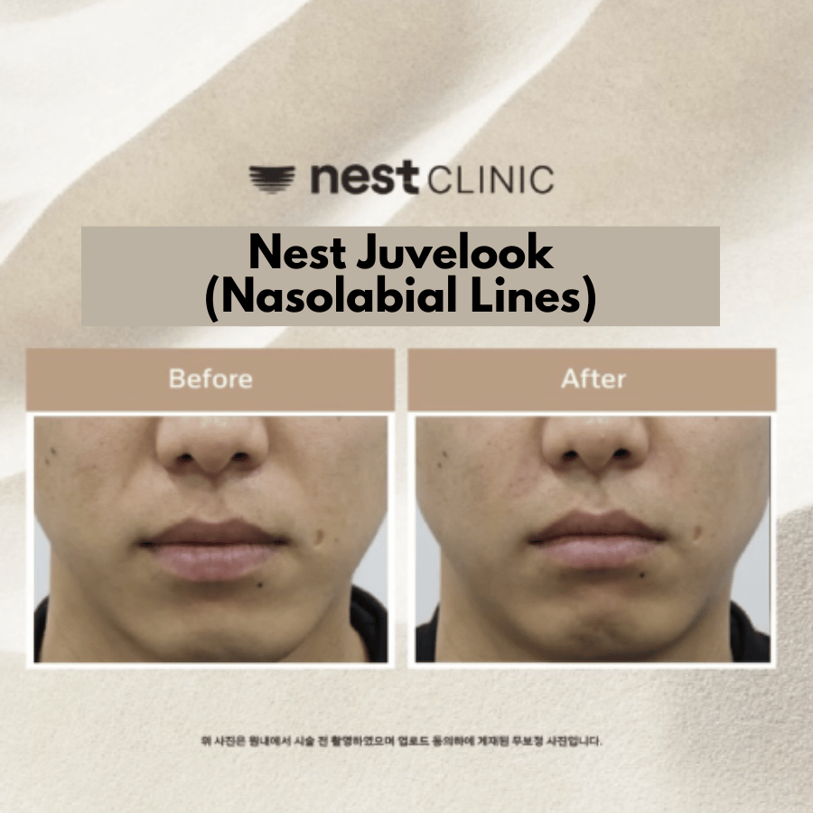 Juvelook Volume (nasolabial lines) before and after at Nest Clinic Gangnam