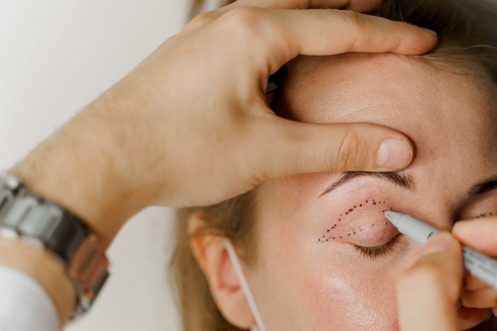 A person is drawing lines on a woman's eye with a marker