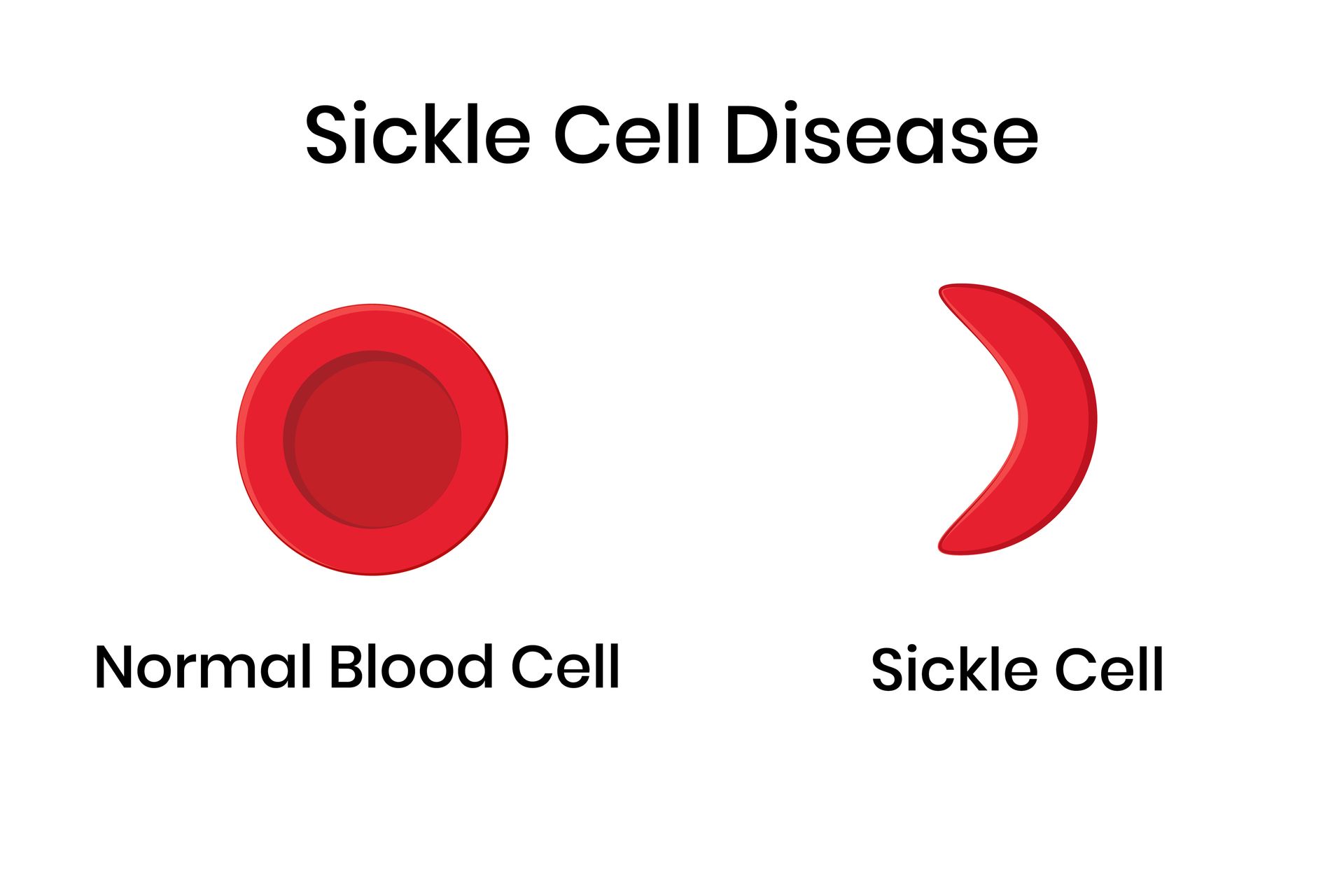 Sickle Cell Disease (SCD)