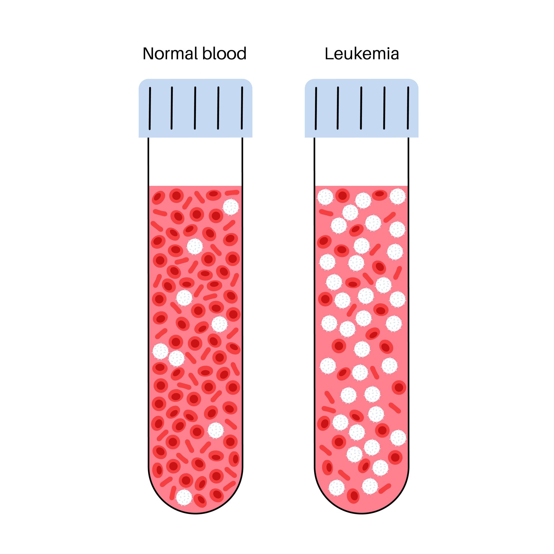 Acute Myeloid Leukemia (FLT3-ITD+)