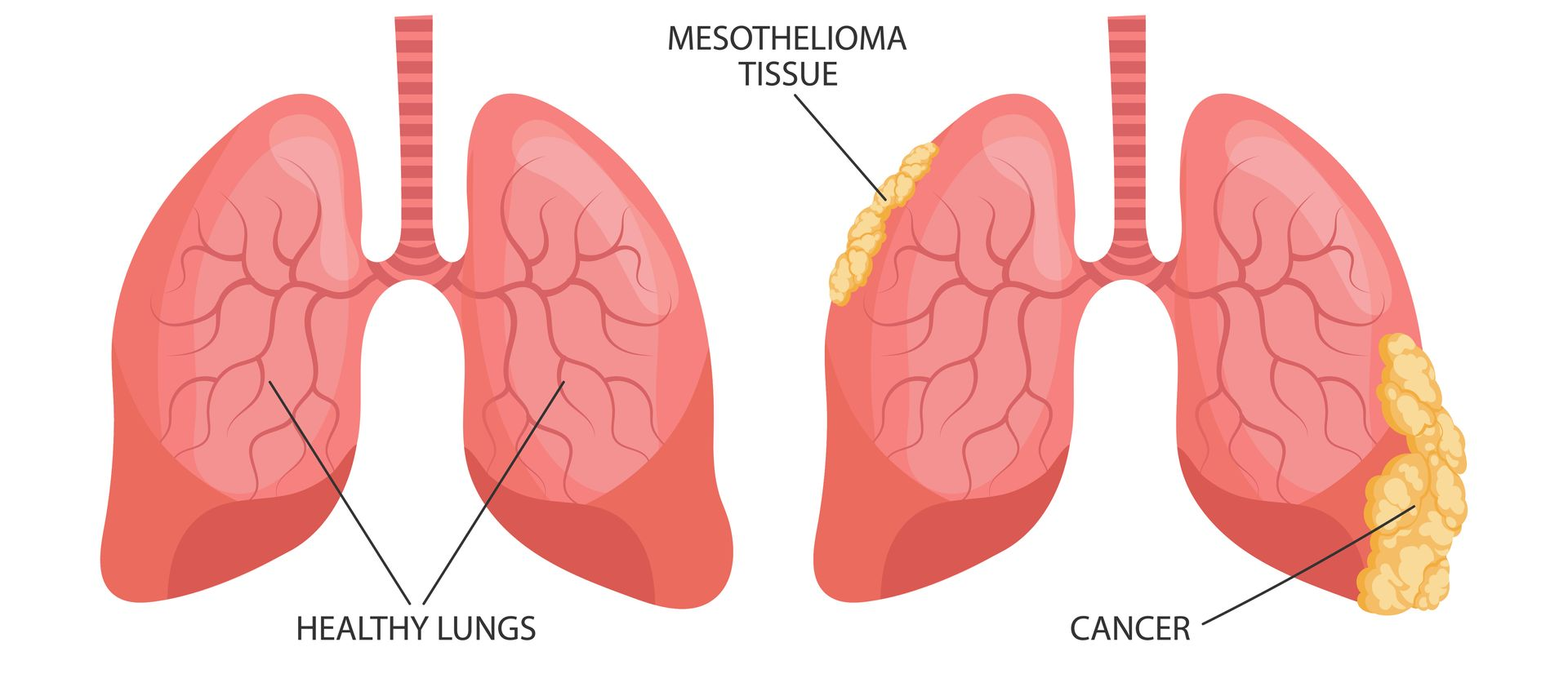 Extensive-Stage Small-Cell Lung Cancer (ES-SCLC)