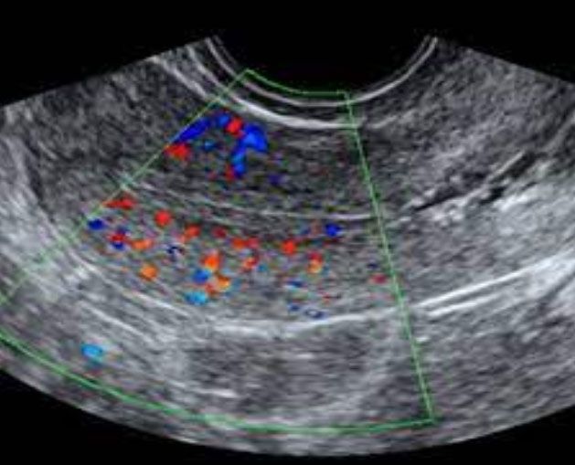 ENDOVAGINAL