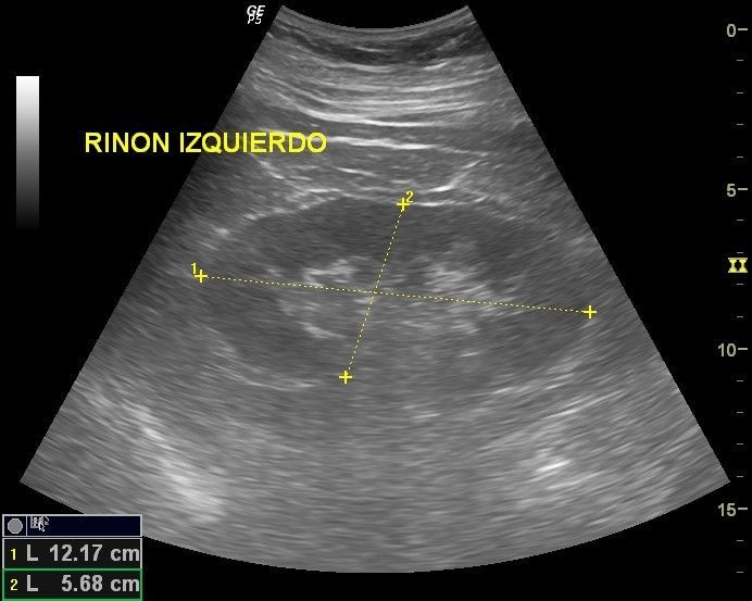 RIÑON IZQUIERDO