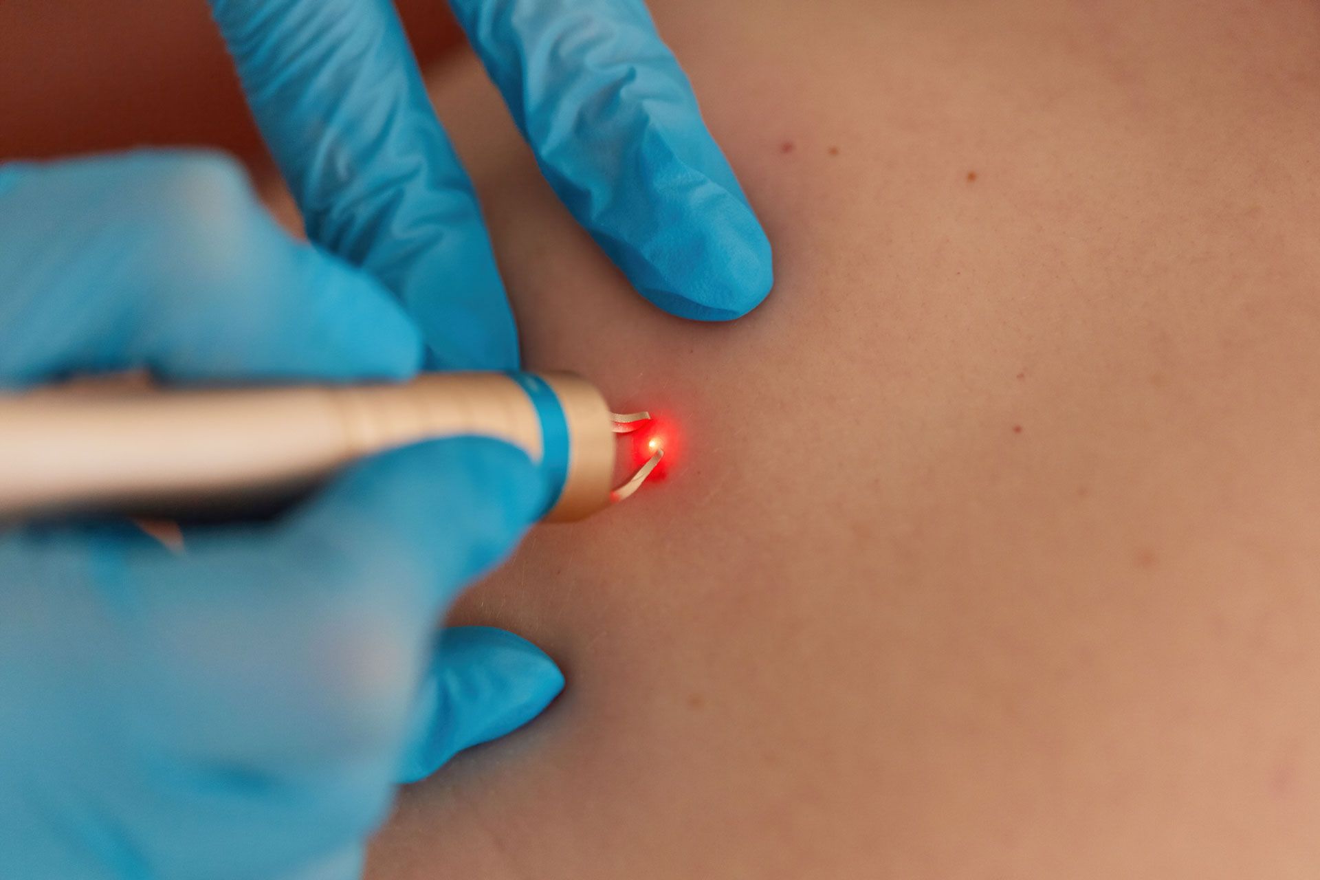 Hands in blue gloves using a laser device on a person's skin. Red laser light visible.