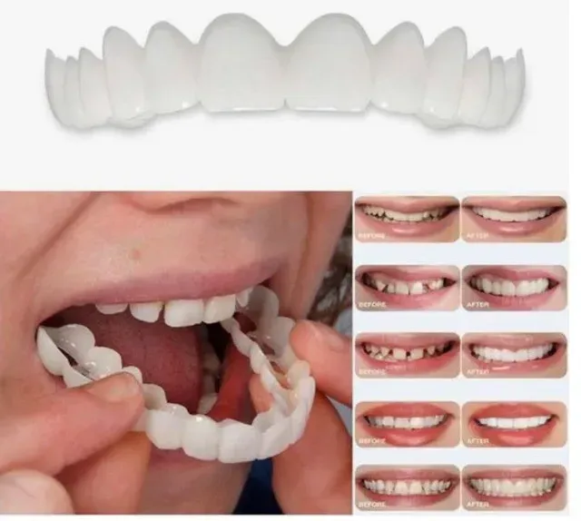 before & after of multiple snap on veneers in collage